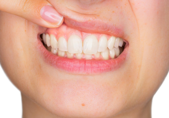 Erzincan Diş Eti Tedavileri