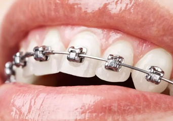 Erzincan Ortodonti Tedavileri
