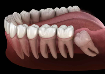 Erzincan Gömülü Diş Ameliyatları